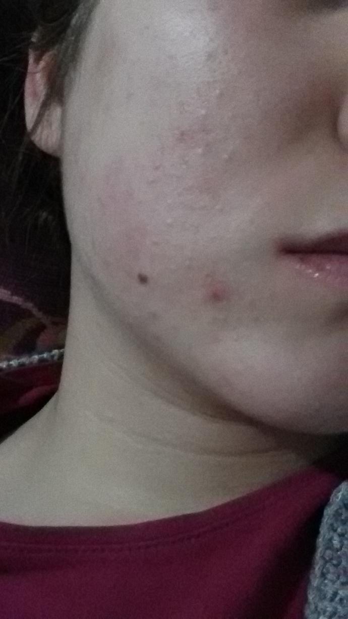 Roaccutane kullanimi 2. Aydayim alerji gibi oldu normal mi? Resimli?