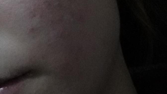 Roaccutane kullanimi 2. Aydayim alerji gibi oldu normal mi? Resimli?