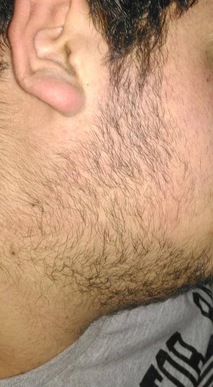 #Bu nasıl sakal boyle ya :D genital bölge kılı gibi çıkıyor resim attım yardımcı  olur musunuz :) ?