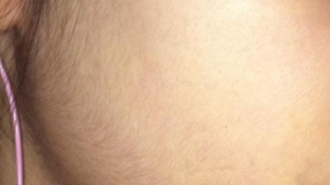 Yüzümde çok fazla tüy var! Yüz bölgesindeki tüyler için çözüm?
