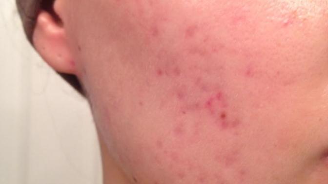 Yüzüm bu şekilde, sizce Roaccutane kullanılabilir mi?