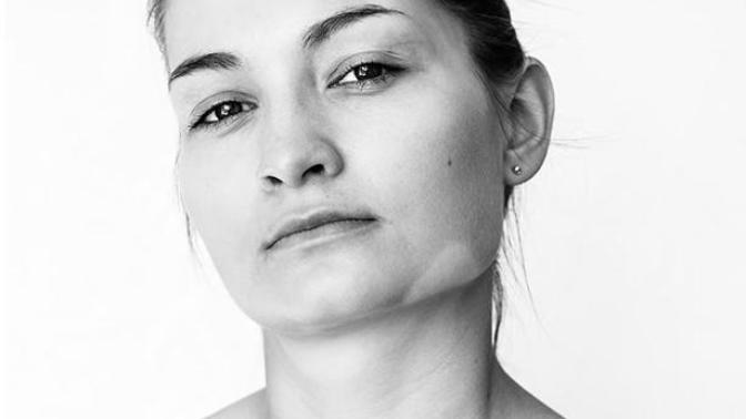 Vitiligo nedir biliyor musunuz?