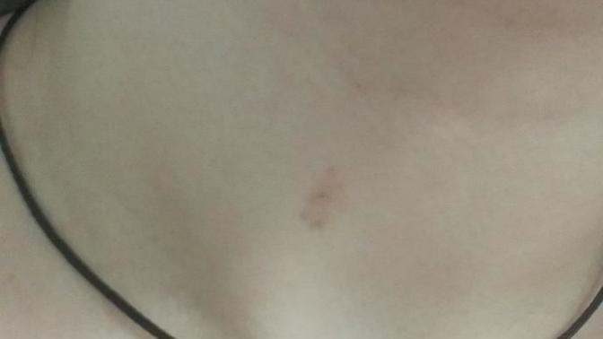 Sigara yanigi gecermi (resimli) ?