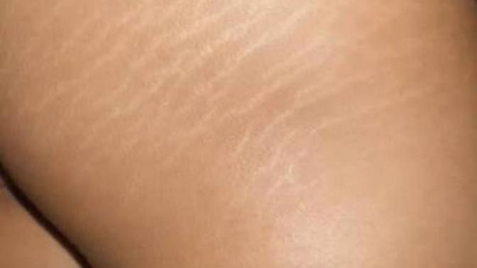 Eşinizin kalçasında çatlak olsa ama sıkı ve şekli güzel olsa yine de soğur musunuz? (Resimli) ?