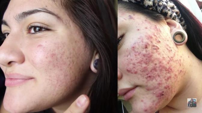 Roaccutane ilacı sivilce lekelerine izlere iyi geliyor mu?