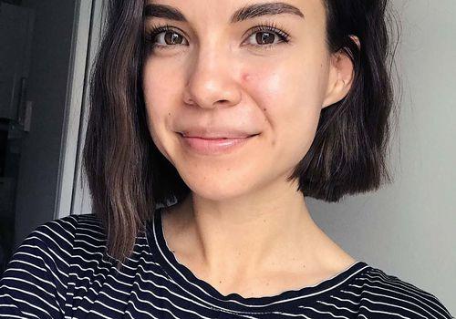 Aknetrent Zayıflatır mı, Kilo Aldırır mı? 