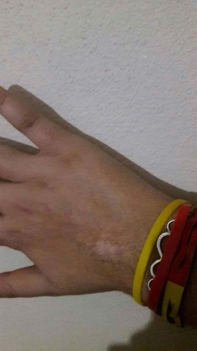 Bio oil yanıklara kullanilirmi ? ACILLL ?