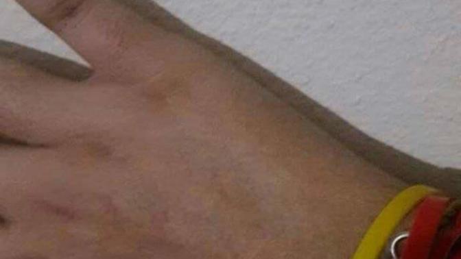 Bio oil yanıklara kullanilirmi? ACILLL?