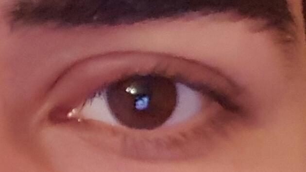 Gözüm mikrop kapti ve şişti ne yapmalıyım :( ?