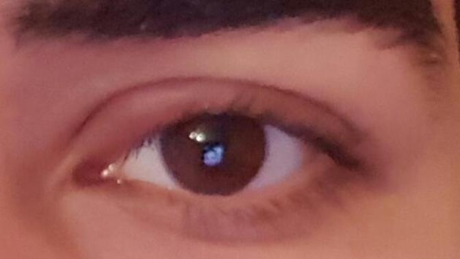 Gözüm mikrop kapti ve şişti ne yapmalıyım :( ?