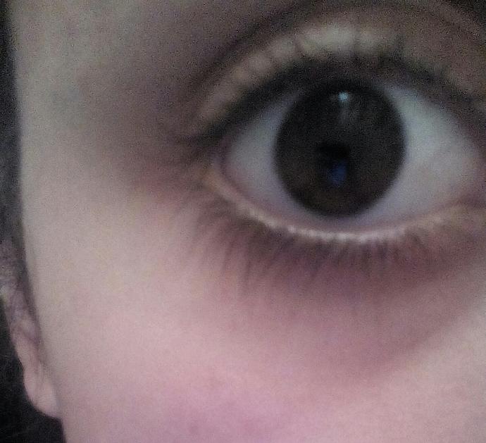 goz alti ve etrafi cok mu mor ?resimli ?