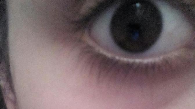 Goz alti ve etrafi cok mu mor? resimli?