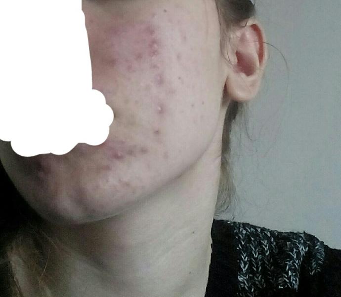 Zoretanin kullanmalı mıyım fotoğraflı?