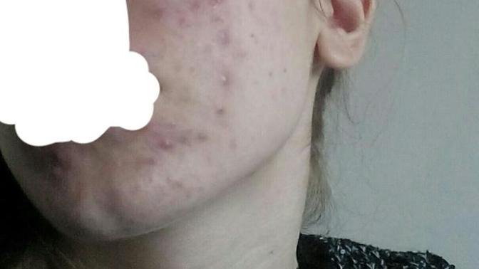 Zoretanin kullanmalı mıyım fotoğraflı?