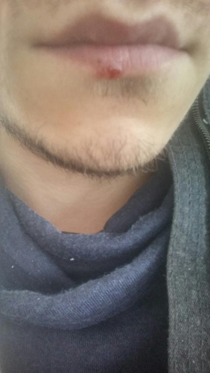 Bu Dudaktaki Yara Nasıl Geçer?