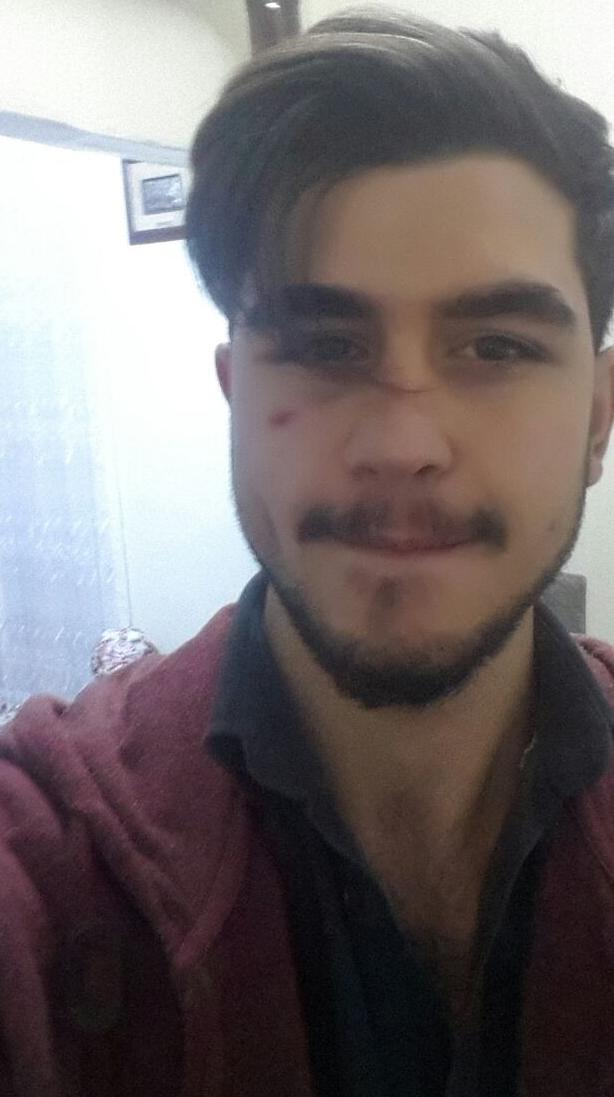 Yara  izi nasıl  geçer  ?