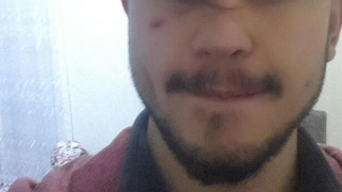 Yara izi nasıl geçer ?