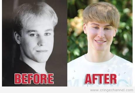 Justin Bieber'a benzemek için estetik yaptırdı?