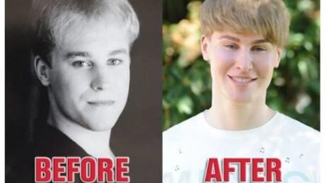 Justin Bieber'a benzemek için estetik yaptırdı?