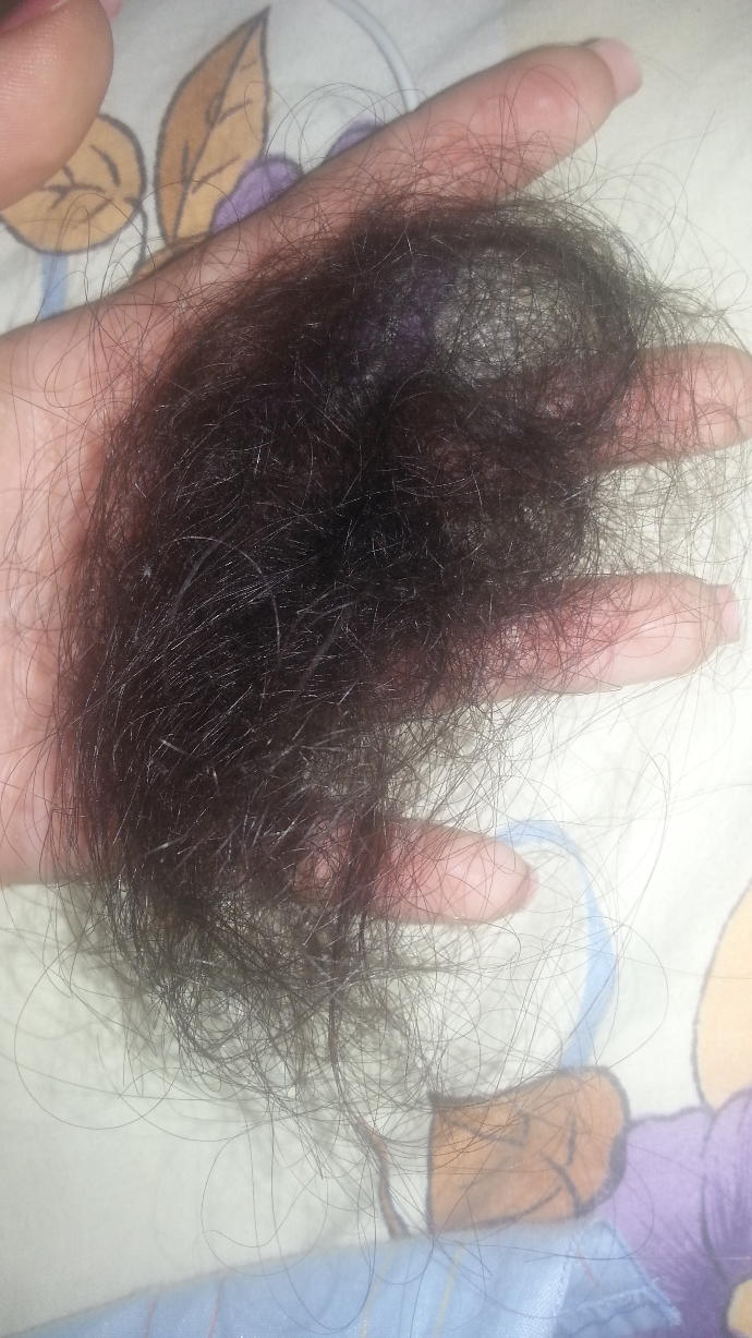 Saçlarımla başım dertte! Kel mi kalıyorum?