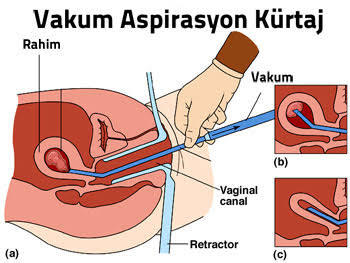 Kızlar kürtaj yaptırmaktan neden bu kadar korkuyor? Çok mu acılı  bir  operasyon?