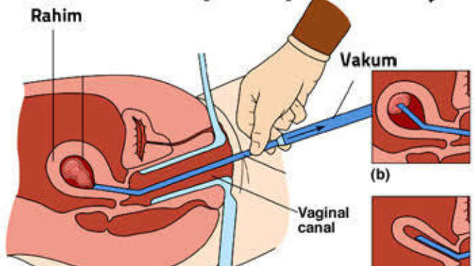 Kızlar kürtaj yaptırmaktan neden bu kadar korkuyor? Çok mu acılı  bir  operasyon?