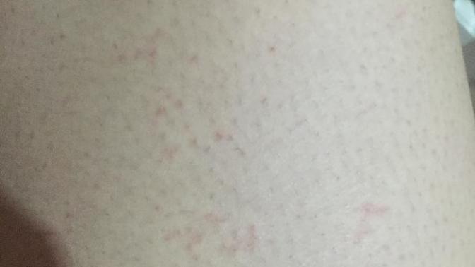 Lazer epilasyon sonra çizgi çizgi kızarık lekeler geçer mi?