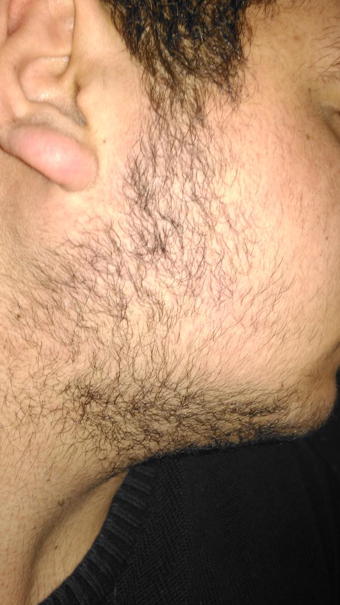 20 yasindayim Sakalım resimdeki durumda :( neden boyle ne yapmam lazim :( ?