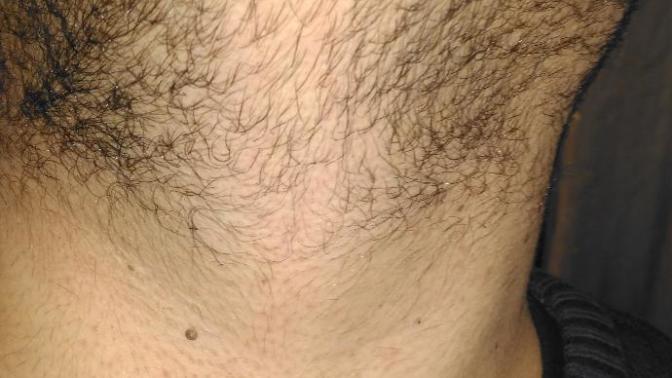 20 yasindayim Sakalım resimdeki durumda :( neden boyle ne yapmam lazim :( ?