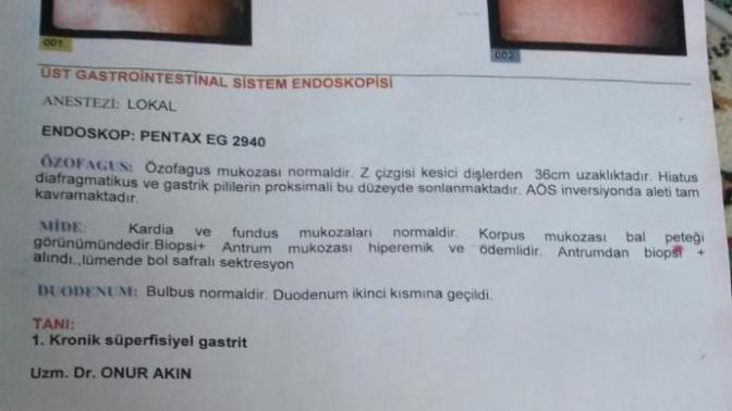 Endoskopi sonucu?