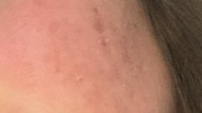 Acnelyse? detay?