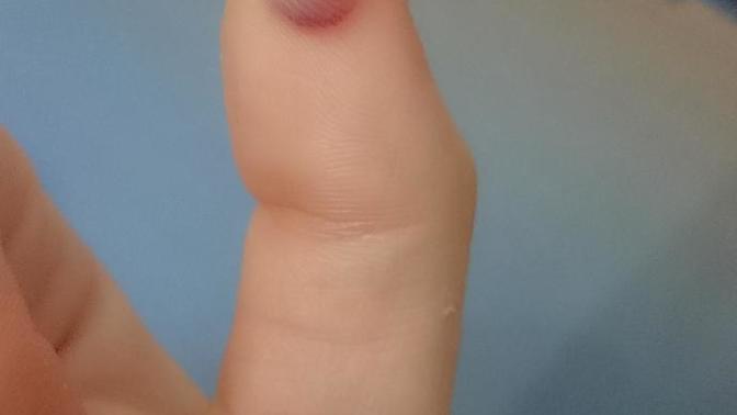 Elimdeki siğili yaktırdım sonra böyle oldu napmalıyım?