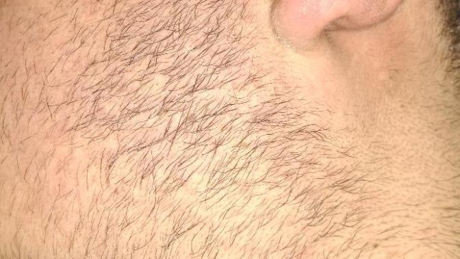 Arkadaşlar genital bölge tüyü gibi sakalım var 😂😂😂😂(resimli) bir baksrmısınız sizce düzelir'mi?