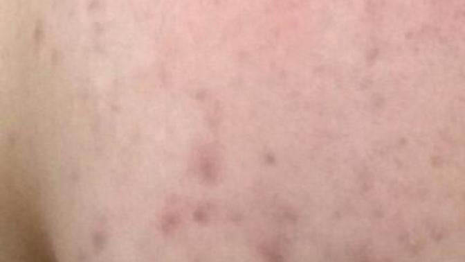 Kırmızı kırmızı olusan sivilceler ve izleri için ilac var mı bldgnz? Cildimin foto. Asagıya koydum?