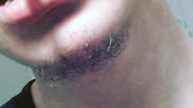 Smiley piercing takıyodum, kendim delmiştim, yaklaşık 3-4 gün önce damağım koptu, tekrar ne zaman birleşir?