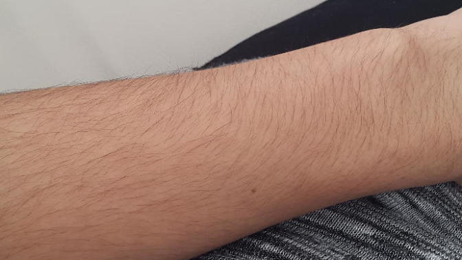 Aşırı zayıflıktan vücutta tüylenme artar mı?
