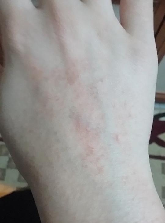 Acnegen kullaniyordum. Elim boyle oldu.. cok korkuyorum ya. Yardim lutfen. Yalvaririm bakin 😭😭?