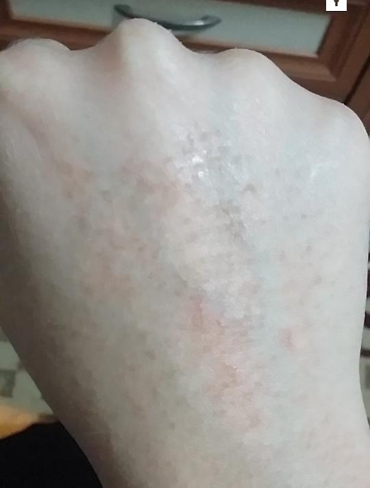 Acnegen kullaniyordum. Elim boyle oldu.. cok korkuyorum ya. Yardim lutfen.Yalvaririm bakin 😭😭???