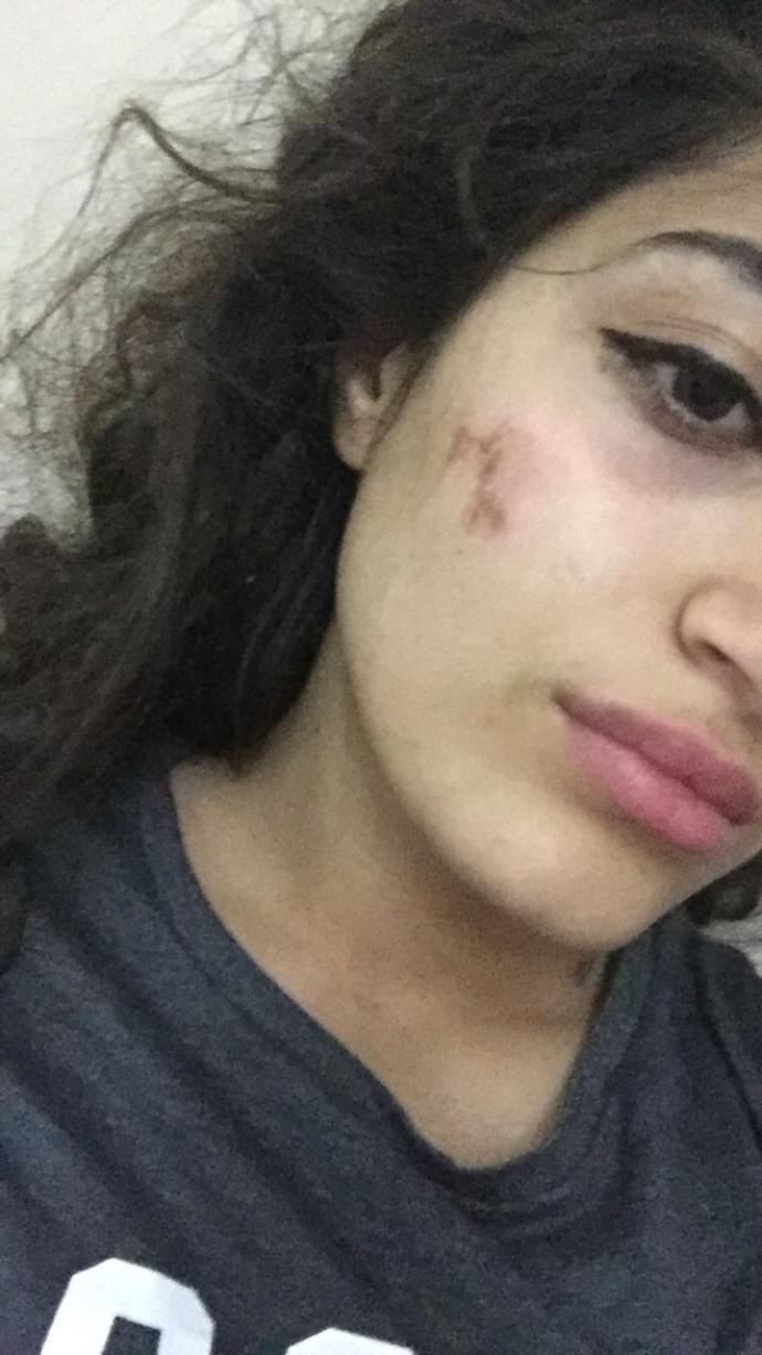 Yüzümdeki yara 1 haftadır geçmedi?