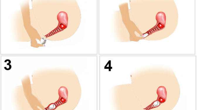 Menstrual Cup (Adet Kabı) Kullanan, bilen var mı Kullanır mısınız?