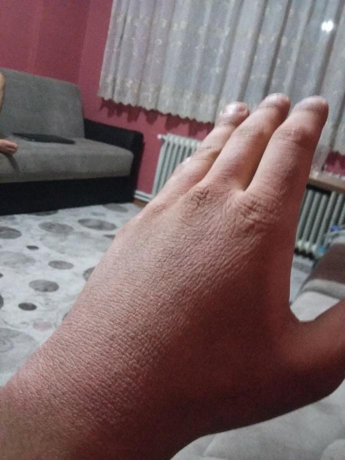 Arkadaşlar benim ellerim baya bir süredir böyle ne yapmam lazım acaba (resimli) ?