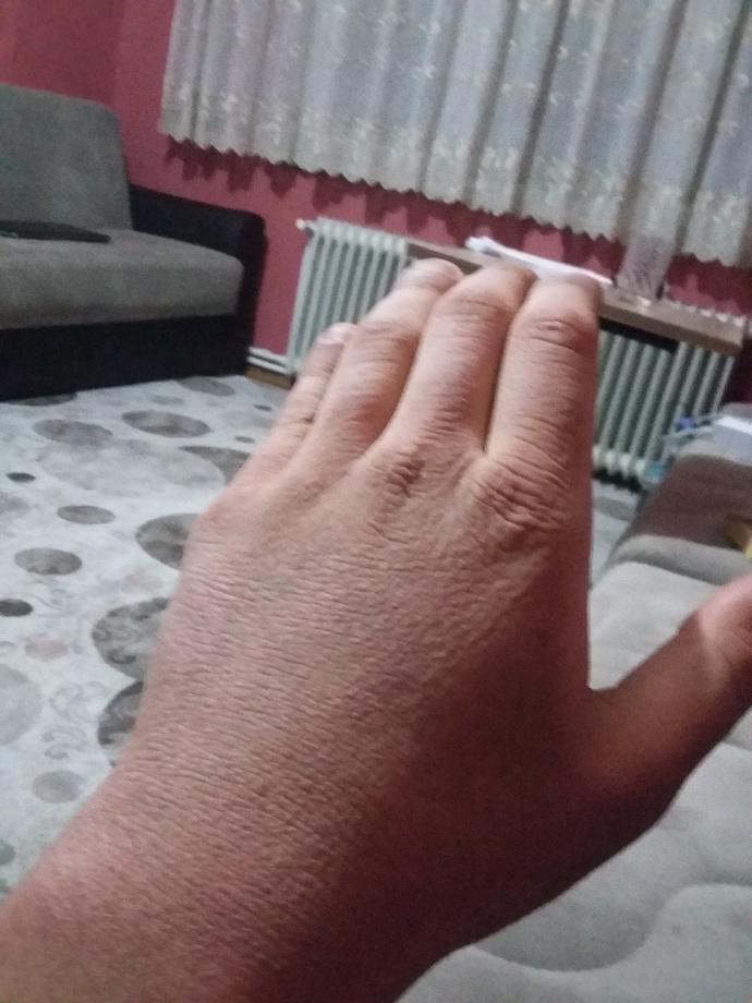 Arkadaşlar benim ellerim baya bir süredir böyle ne yapmam lazım acaba (resimli) ?