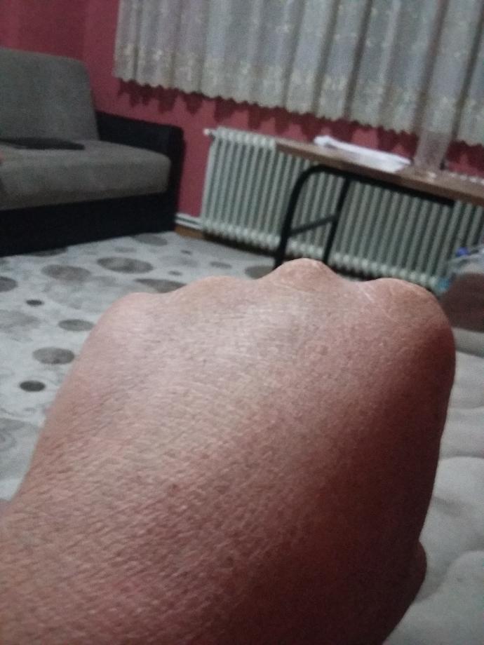 Arkadaşlar benim ellerim baya bir süredir böyle ne yapmam lazım acaba (resimli) ?