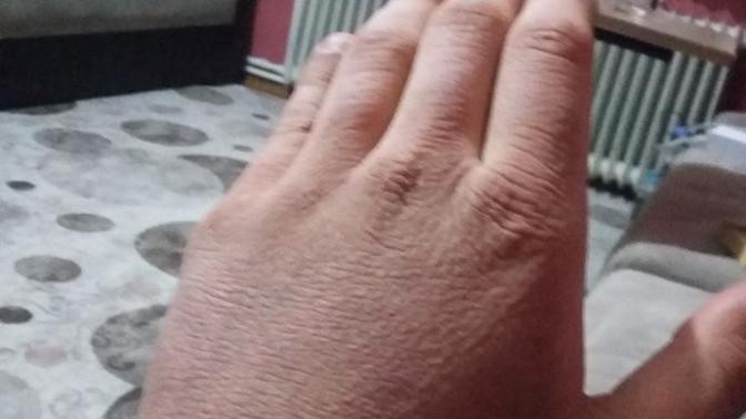 Arkadaşlar benim ellerim baya bir süredir böyle ne yapmam lazım acaba (resimli) ?