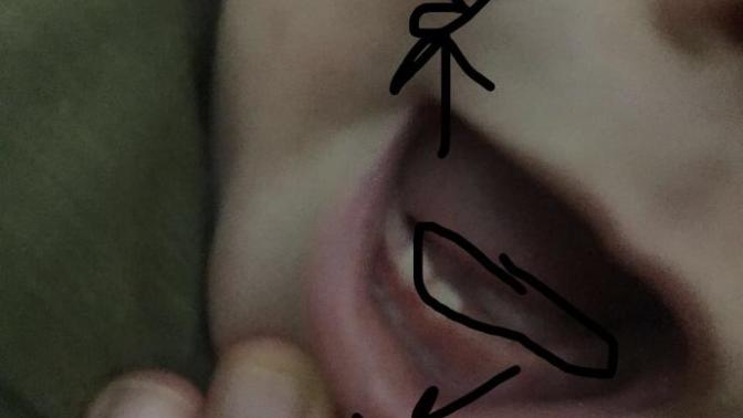 Kardeşimin dilinin altındaki şey ne? Bebek kardeşi/çocuğu olan bakabilir mi?