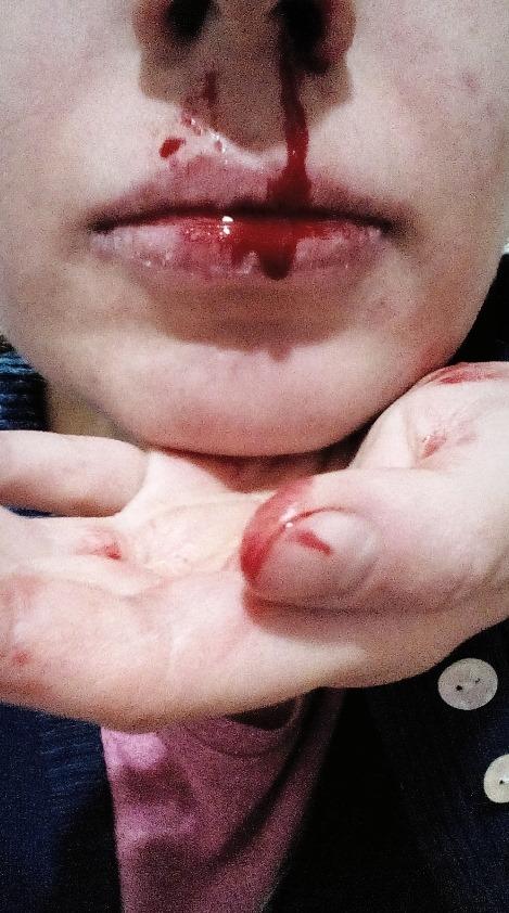 Rauccutane hapının cok kotu etkılerı var bılenler  var mı bakın resımlı, ilacı bırakıyım mı?