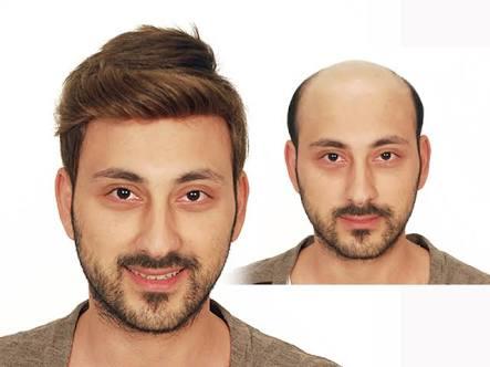 Saç ekimi mi? Protez saçmı? Sizce?