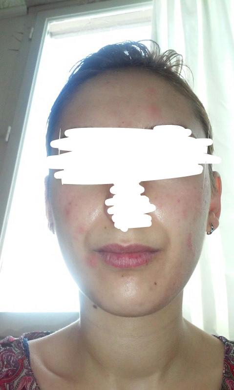 Cildimdekiler sivilce mi alerji mi?