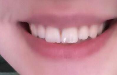 Dis teli taktirmak istiyorum sizce cok mu kotu dislerim :/ ???