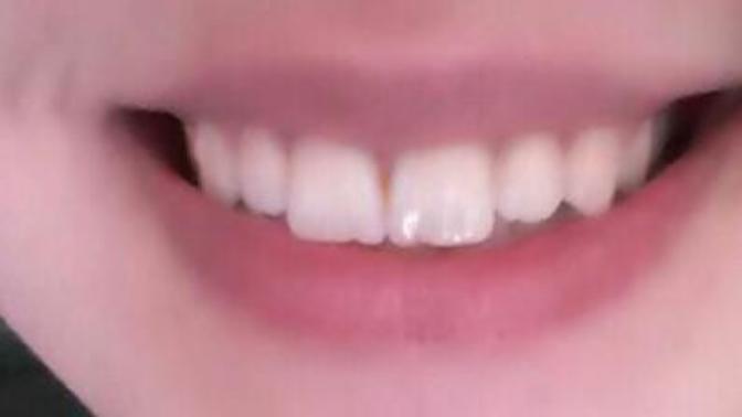 Dis teli taktirmak istiyorum sizce cok mu kotu dislerim :/ ?
